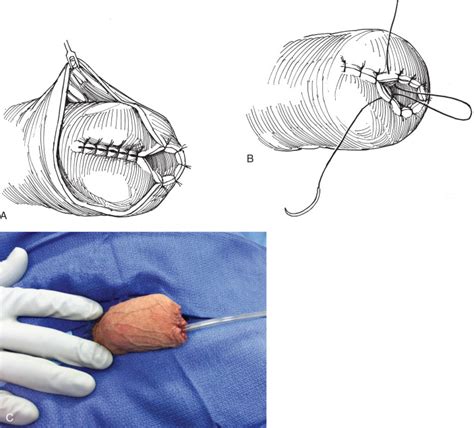 Surgery is the most common treatment for all stages of penile cancer. . Urination after partial penectomy